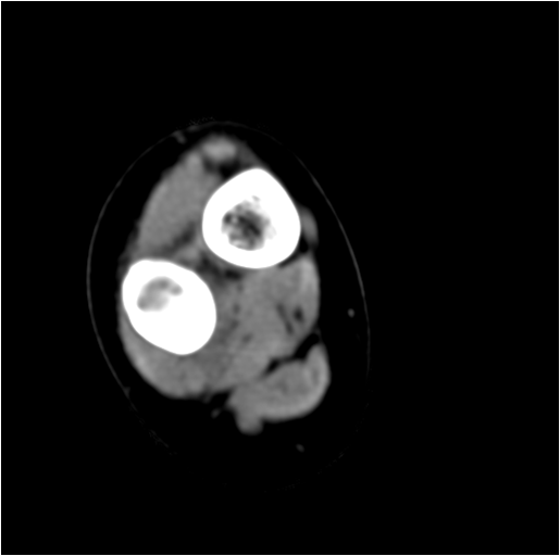 【病例】右腓骨下段骨纤维结构不良 【病例】右腓骨下段骨纤维结构不良