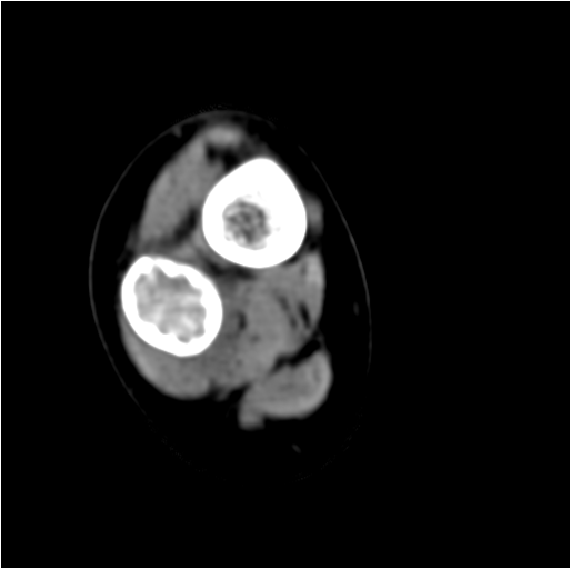 【病例】右腓骨下段骨纤维结构不良 【病例】右腓骨下段骨纤维结构不良