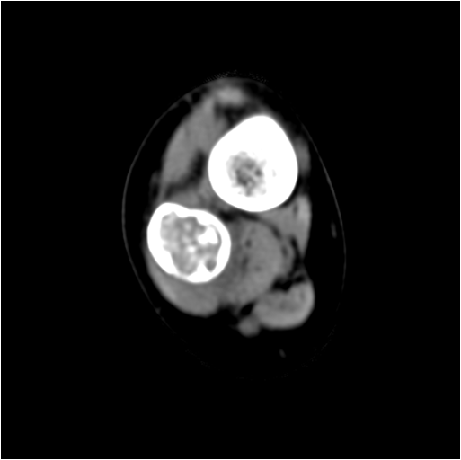 【病例】右腓骨下段骨纤维结构不良 【病例】右腓骨下段骨纤维结构不良