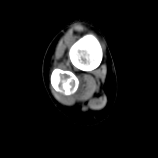 【病例】右腓骨下段骨纤维结构不良 【病例】右腓骨下段骨纤维结构不良