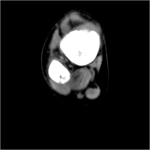 【病例】右腓骨下段骨纤维结构不良 【病例】右腓骨下段骨纤维结构不良
