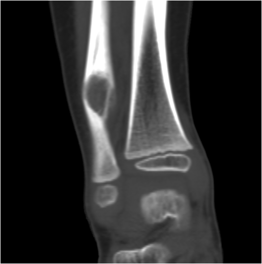 【病例】右腓骨下段骨纤维结构不良 【病例】右腓骨下段骨纤维结构不良