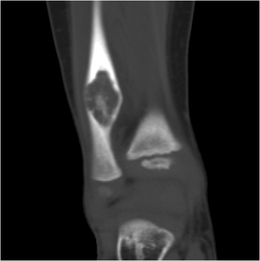 【病例】右腓骨下段骨纤维结构不良 【病例】右腓骨下段骨纤维结构不良