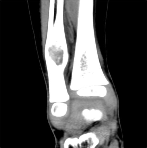 【病例】右腓骨下段骨纤维结构不良 【病例】右腓骨下段骨纤维结构不良