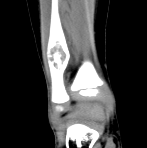 【病例】右腓骨下段骨纤维结构不良 【病例】右腓骨下段骨纤维结构不良