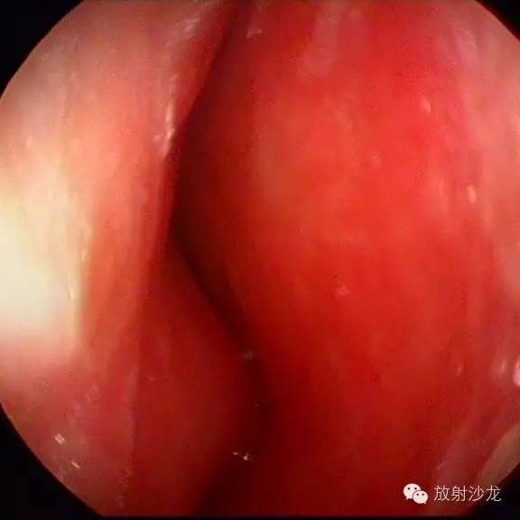 【病例】巨细胞修复性肉芽肿1例CT影像表现