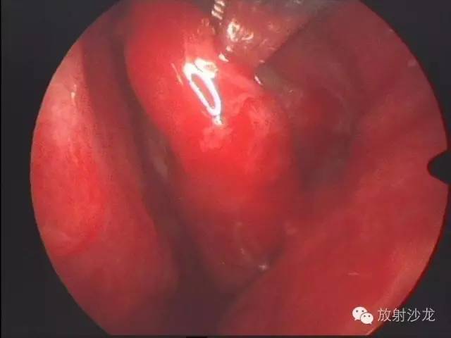 【病例】巨细胞修复性肉芽肿1例CT影像表现