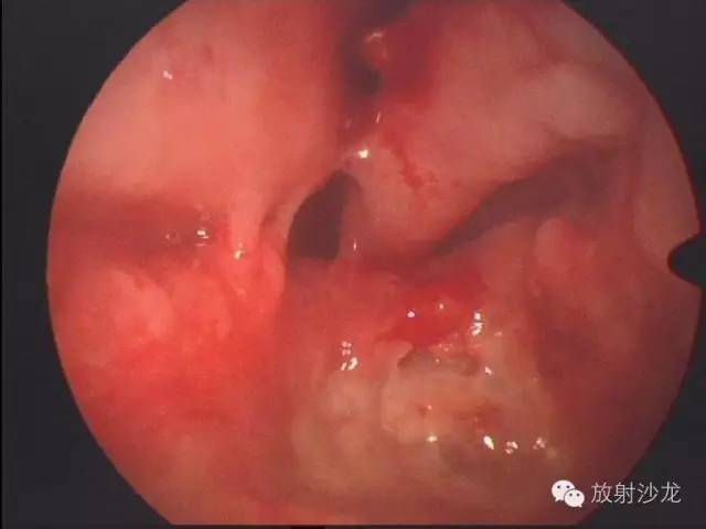 【病例】巨细胞修复性肉芽肿1例CT影像表现