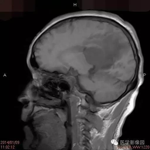 【病例】侧脑室淋巴瘤1例CT及MR影像表现 【病例】侧脑室淋巴瘤1例CT及MR影像表现