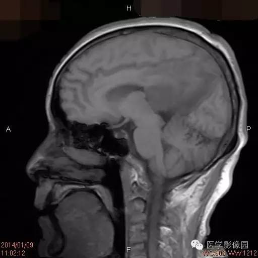 【病例】侧脑室淋巴瘤1例CT及MR影像表现 【病例】侧脑室淋巴瘤1例CT及MR影像表现