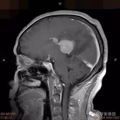 【病例】侧脑室淋巴瘤1例CT及MR影像表现 【病例】侧脑室淋巴瘤1例CT及MR影像表现