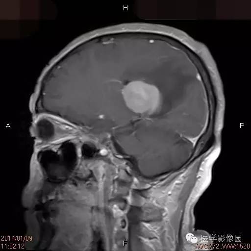 【病例】侧脑室淋巴瘤1例CT及MR影像表现 【病例】侧脑室淋巴瘤1例CT及MR影像表现