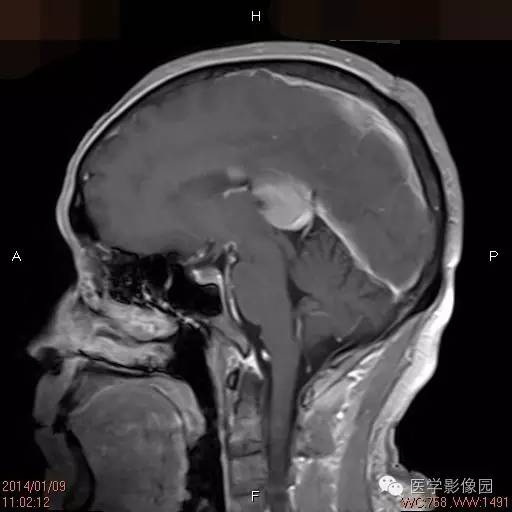 【病例】侧脑室淋巴瘤1例CT及MR影像表现 【病例】侧脑室淋巴瘤1例CT及MR影像表现
