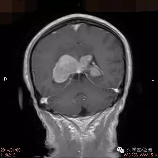 【病例】侧脑室淋巴瘤1例CT及MR影像表现 【病例】侧脑室淋巴瘤1例CT及MR影像表现