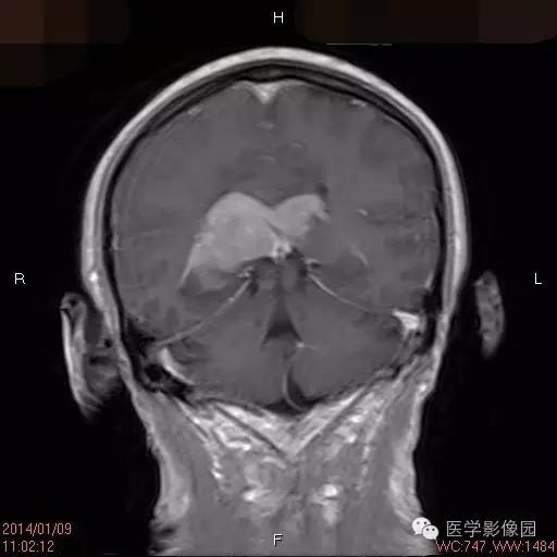 【病例】侧脑室淋巴瘤1例CT及MR影像表现 【病例】侧脑室淋巴瘤1例CT及MR影像表现