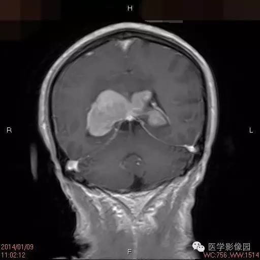 【病例】侧脑室淋巴瘤1例CT及MR影像表现 【病例】侧脑室淋巴瘤1例CT及MR影像表现