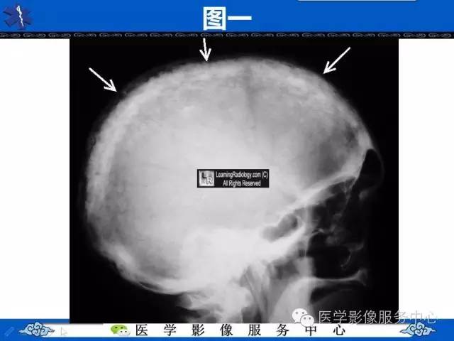 【影像征象】棉絮征——佩吉特骨病Paget Disease