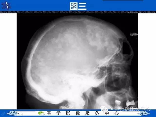 【影像征象】棉絮征——佩吉特骨病Paget Disease