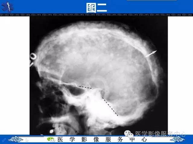 【影像征象】棉絮征——佩吉特骨病Paget Disease