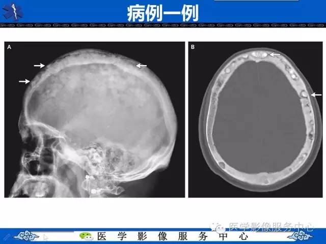 【影像征象】棉絮征——佩吉特骨病Paget Disease