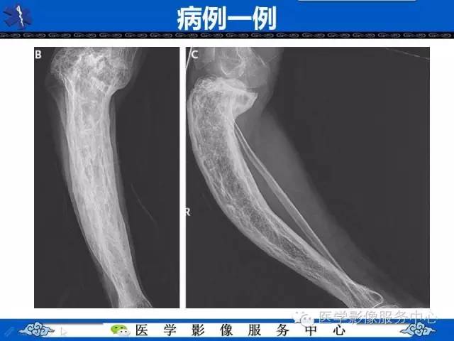 【影像征象】棉絮征——佩吉特骨病Paget Disease