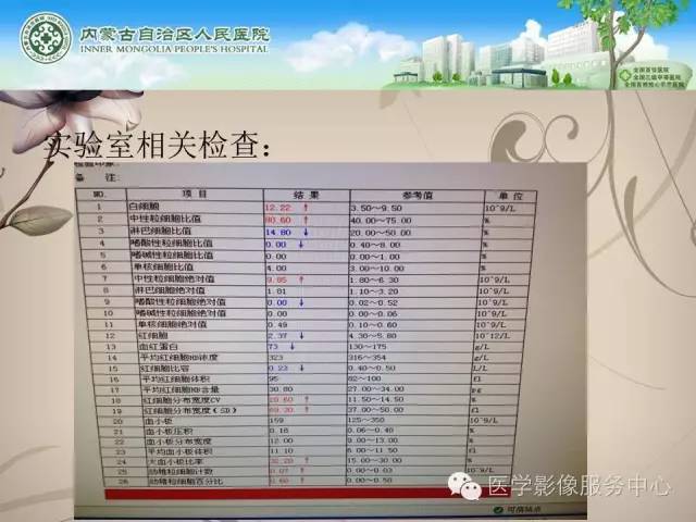 【病例】肺韦格氏肉芽肿1例CT影像表现
