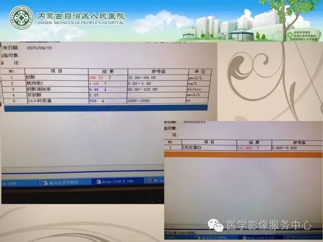 【病例】肺韦格氏肉芽肿1例CT影像表现