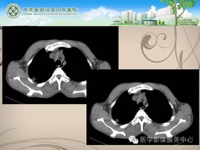 【病例】肺韦格氏肉芽肿1例CT影像表现