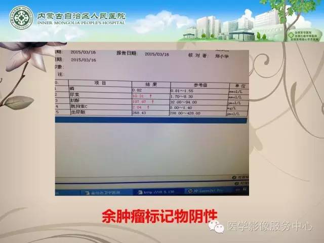 【病例】肺韦格氏肉芽肿1例CT影像表现