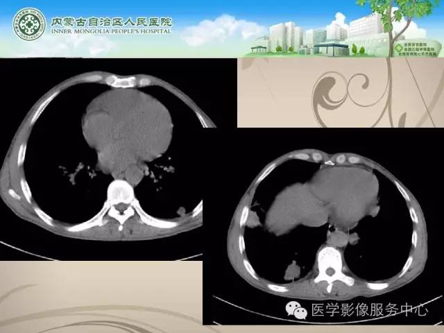 【病例】肺韦格氏肉芽肿1例CT影像表现