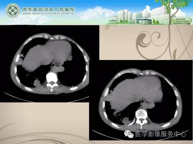 【病例】肺韦格氏肉芽肿1例CT影像表现