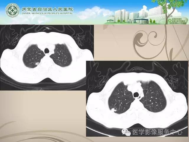 【病例】肺韦格氏肉芽肿1例CT影像表现