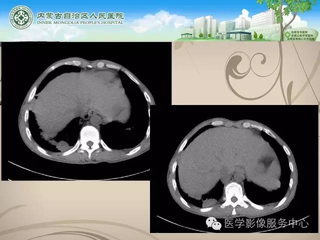 【病例】肺韦格氏肉芽肿1例CT影像表现