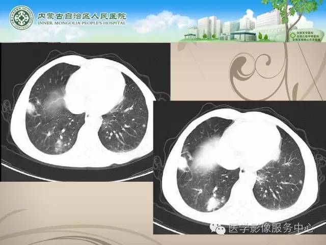 【病例】肺韦格氏肉芽肿1例CT影像表现