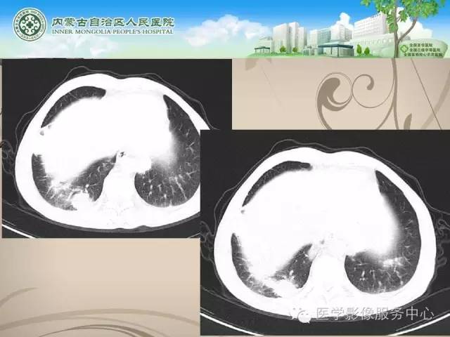 【病例】肺韦格氏肉芽肿1例CT影像表现