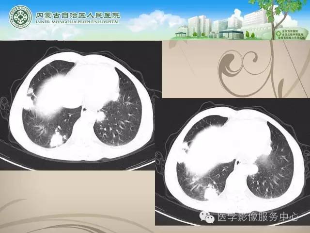 【病例】肺韦格氏肉芽肿1例CT影像表现