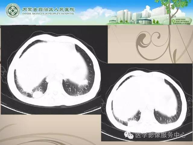 【病例】肺韦格氏肉芽肿1例CT影像表现