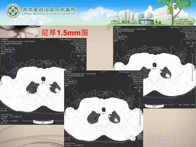 【病例】肺韦格氏肉芽肿1例CT影像表现