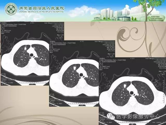 【病例】肺韦格氏肉芽肿1例CT影像表现