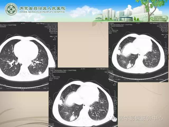 【病例】肺韦格氏肉芽肿1例CT影像表现