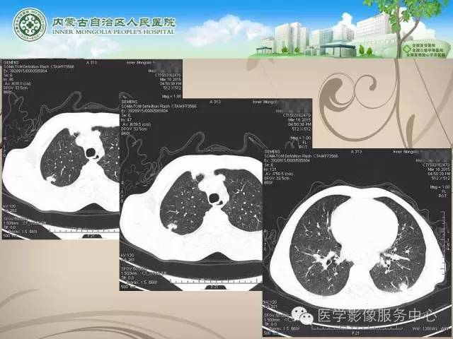 【病例】肺韦格氏肉芽肿1例CT影像表现