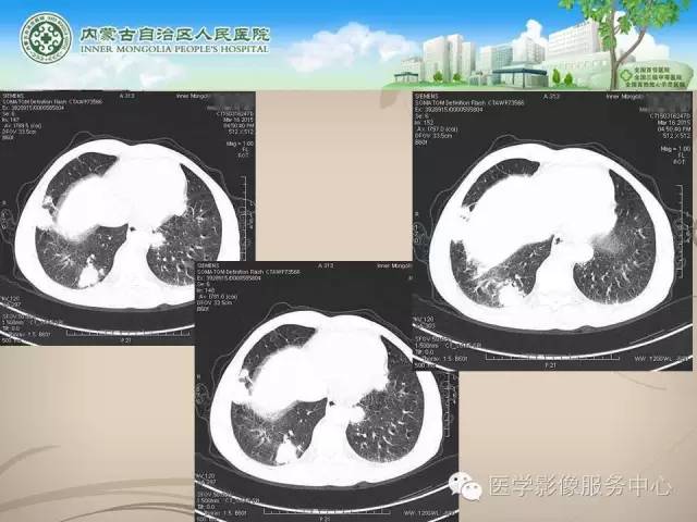 【病例】肺韦格氏肉芽肿1例CT影像表现