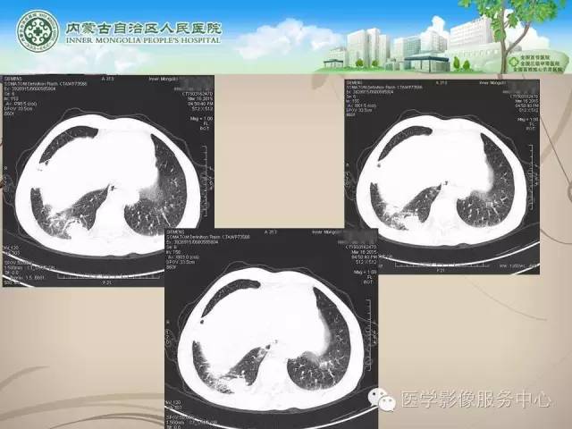 【病例】肺韦格氏肉芽肿1例CT影像表现