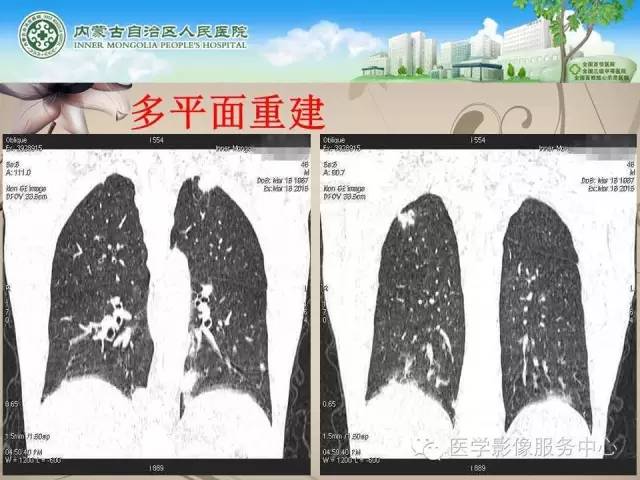 【病例】肺韦格氏肉芽肿1例CT影像表现