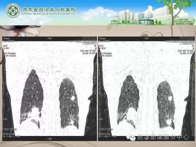 【病例】肺韦格氏肉芽肿1例CT影像表现