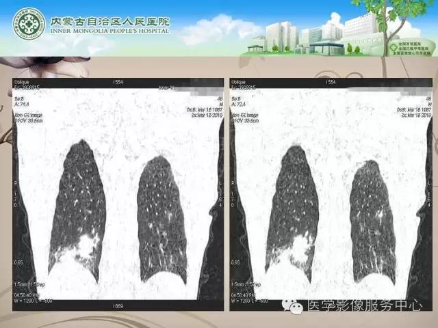 【病例】肺韦格氏肉芽肿1例CT影像表现