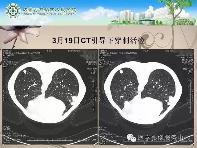 【病例】肺韦格氏肉芽肿1例CT影像表现