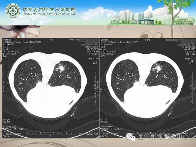 【病例】肺韦格氏肉芽肿1例CT影像表现