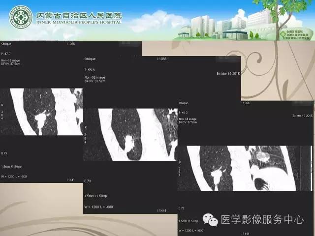 【病例】肺韦格氏肉芽肿1例CT影像表现