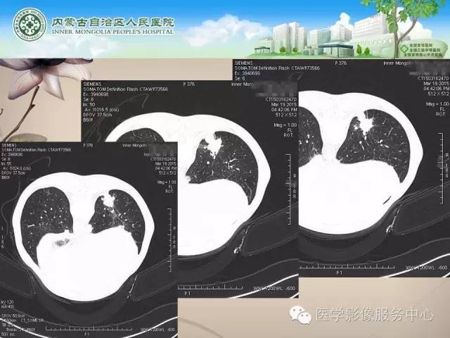 【病例】肺韦格氏肉芽肿1例CT影像表现
